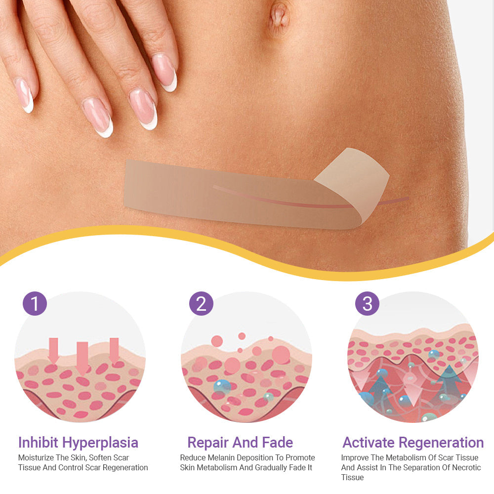 ✅Official Store |Ourlyard® Hyaluronic Acid Nano Microneedle Repair Tape☑️(Treatment of old and new scars, reduction of surgical scars, stretch marks, keloids, acne, burns, warts, dermatomes and varicose veins)✅
